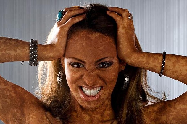 Melasma