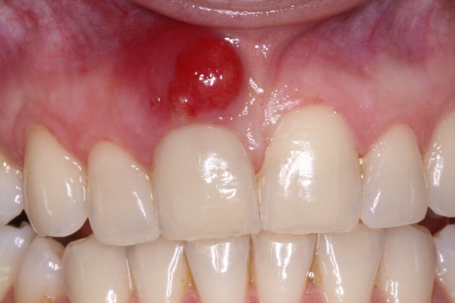 Absces