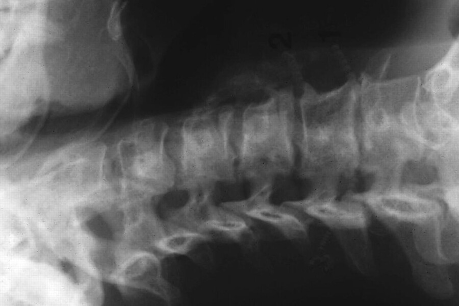 Pagetova choroba