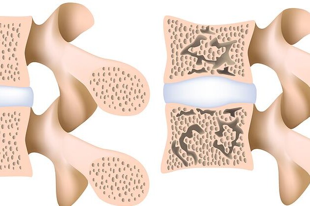 Osteoporóza