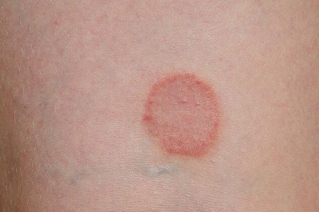 Lichen planus