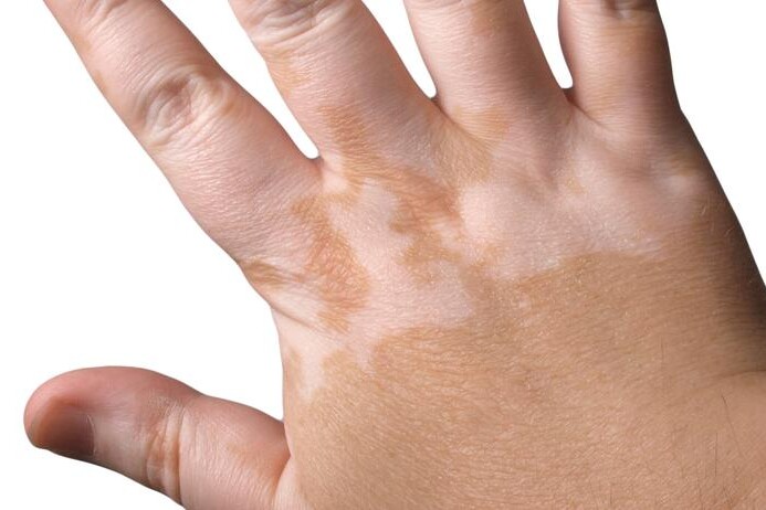 Vitiligo u dětí