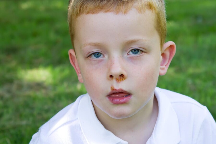 Impetigo u dětí