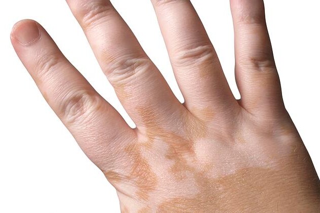 Vitiligo
