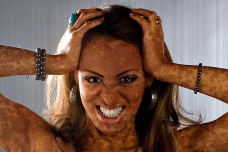Melasma
