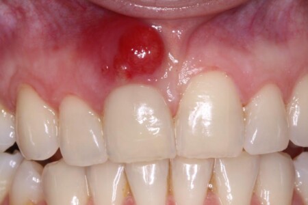 Absces